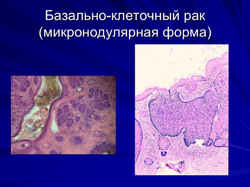 Базально-клеточный рак (микронодулярная форма)